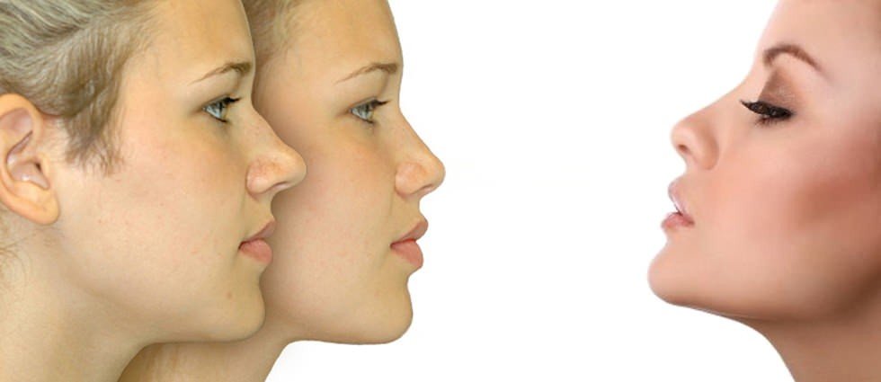 Rinoplastica Salerno Rinolastica-Salerno Rinoplastica Salerno  